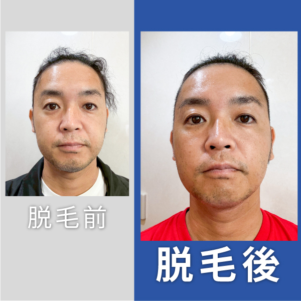 ヒゲ脱毛2回目のお客様